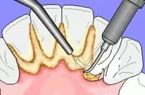 gingiva atrophy gingiva atrophy